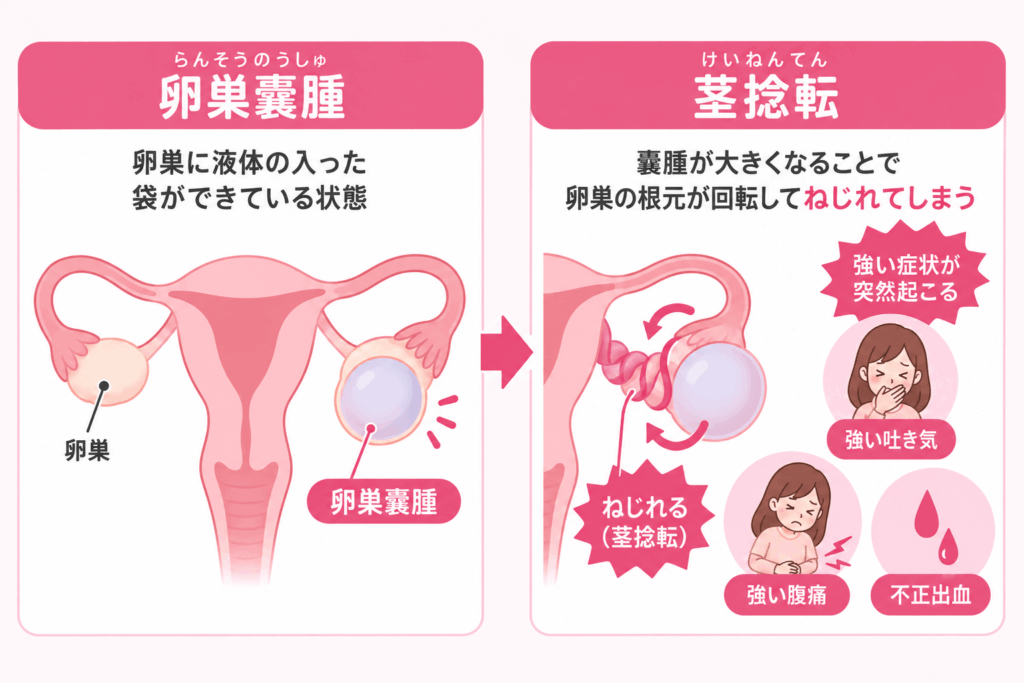 卵巣嚢腫