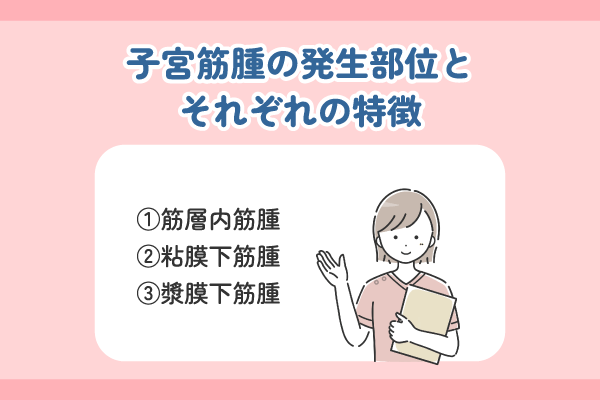 子宮筋腫の発生部位とそれぞれの特徴