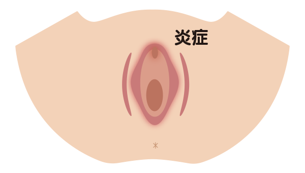 性器が炎症を起こしているイラスト