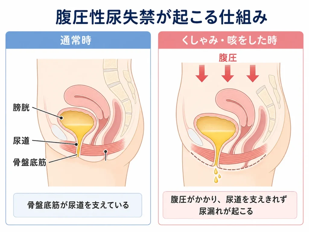 くしゃみや咳で尿漏れが起こるのは「腹圧性尿失禁」