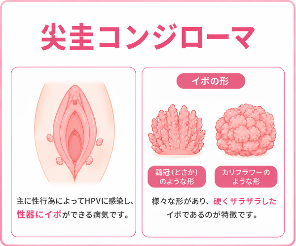 尖圭コンジローマ