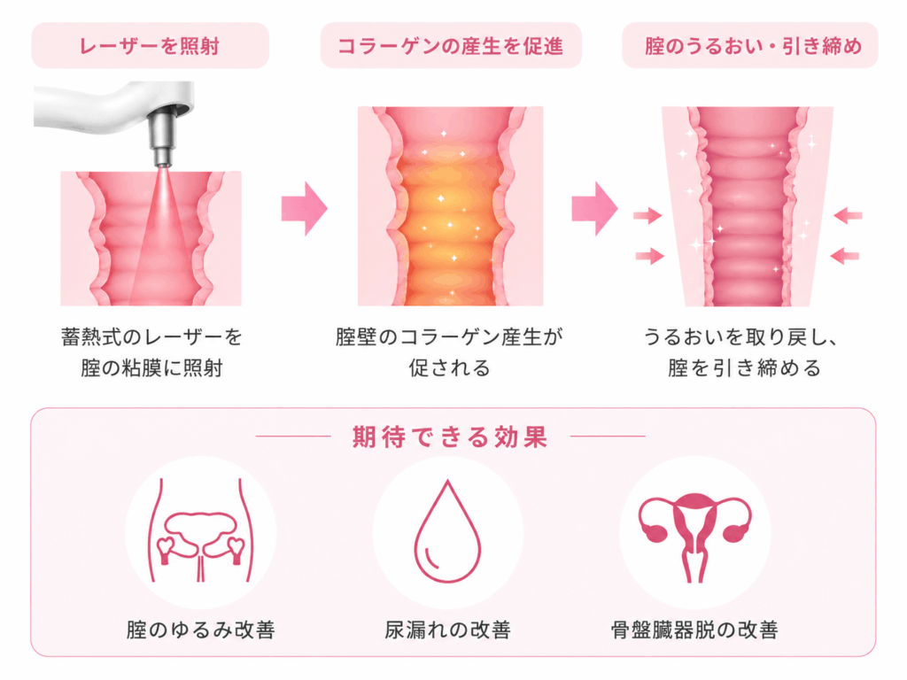 インティマレーザー