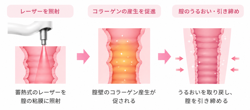 腟レーザー