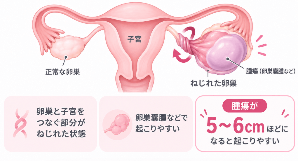 卵巣茎捻転