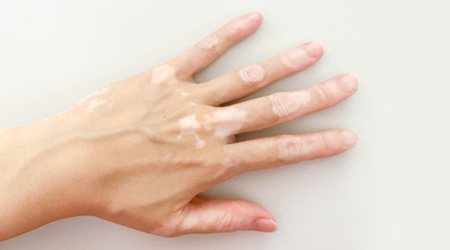 白斑症のイメージ画像