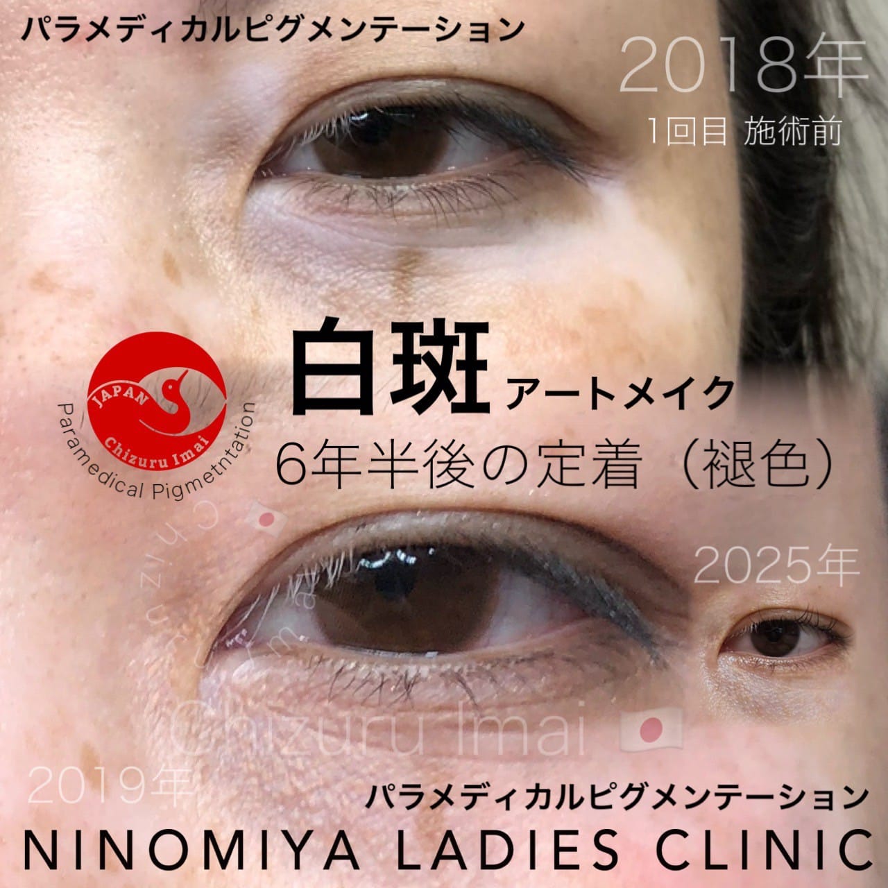 【白斑】医療アートメイク