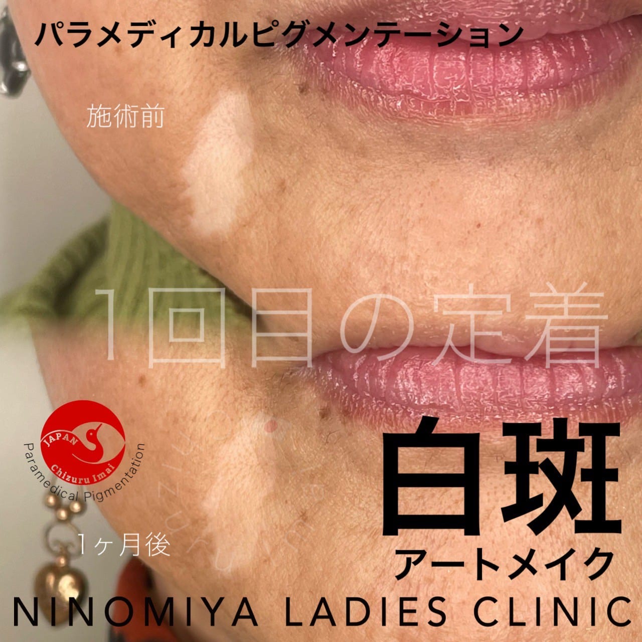 【白斑】医療アートメイク