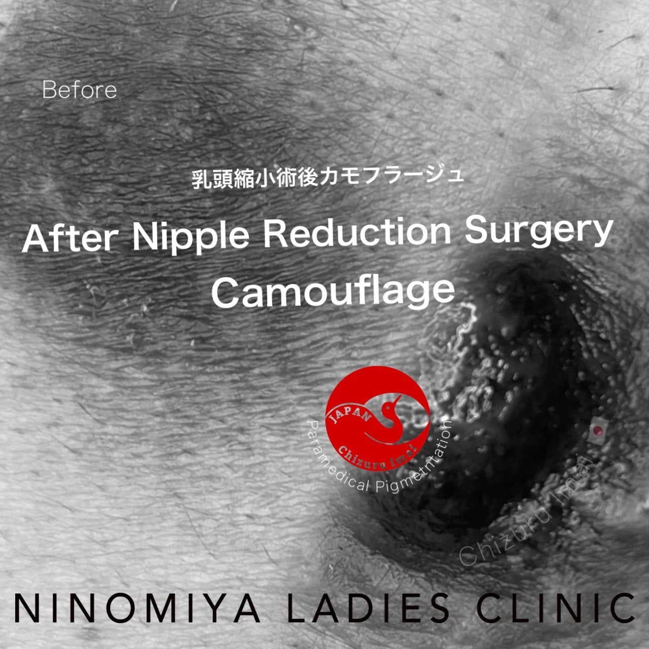 【乳輪・乳頭】医療アートメイク