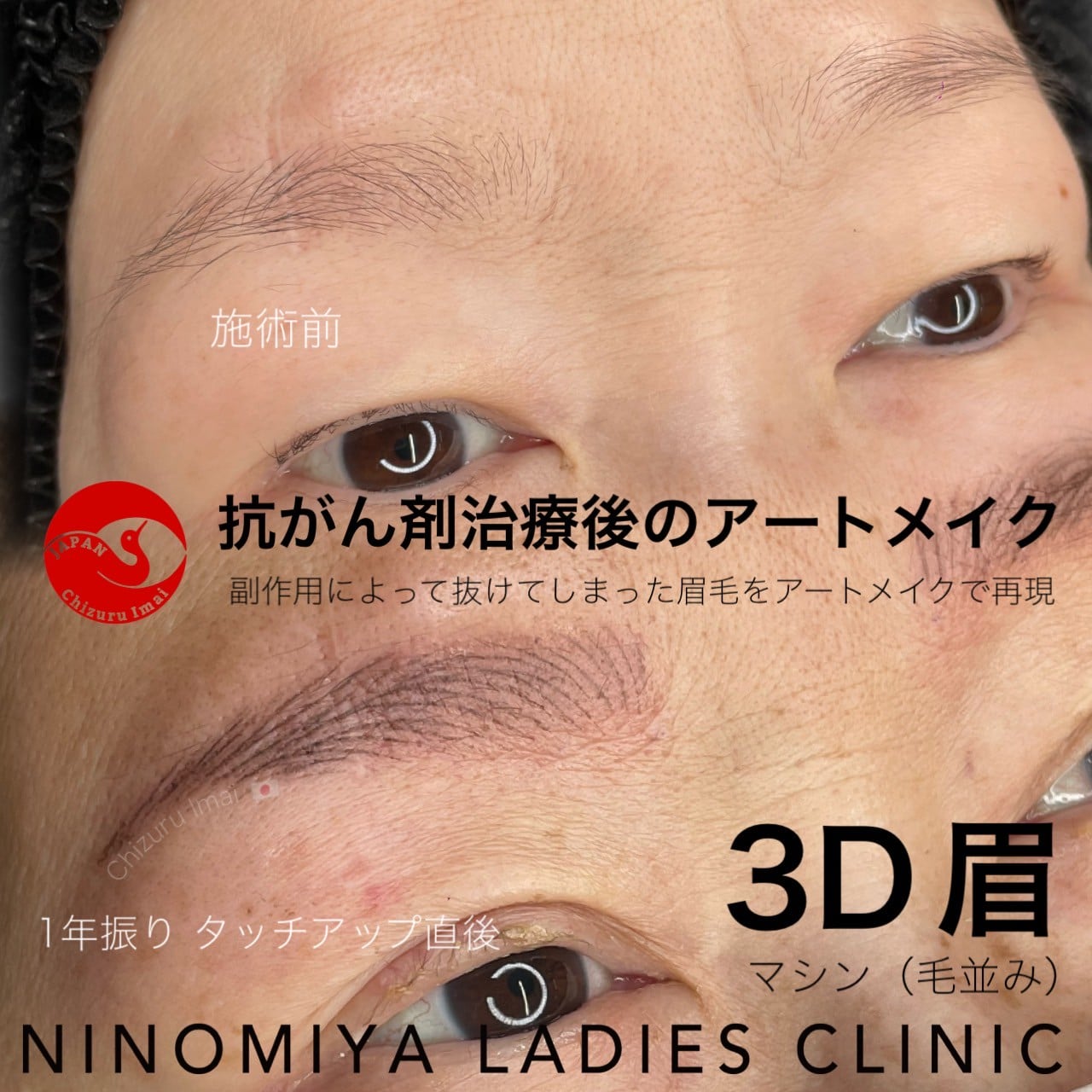 【３D眉】毛並み　抗がん剤治療後　医療アートメイク