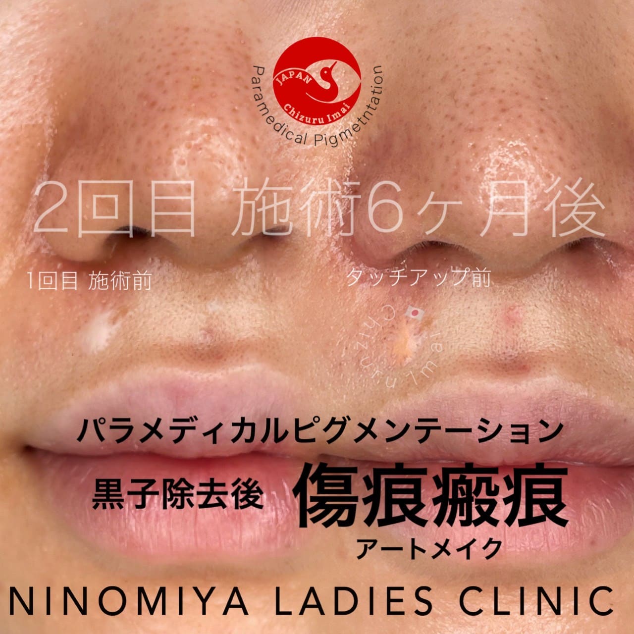 【傷痕・瘢痕】医療アートメイク