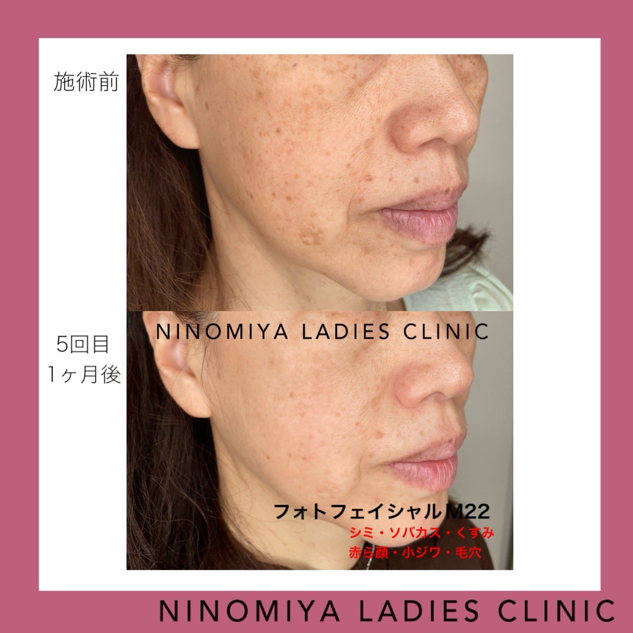 【フォトフェイシャル M22】光（美白）治療　