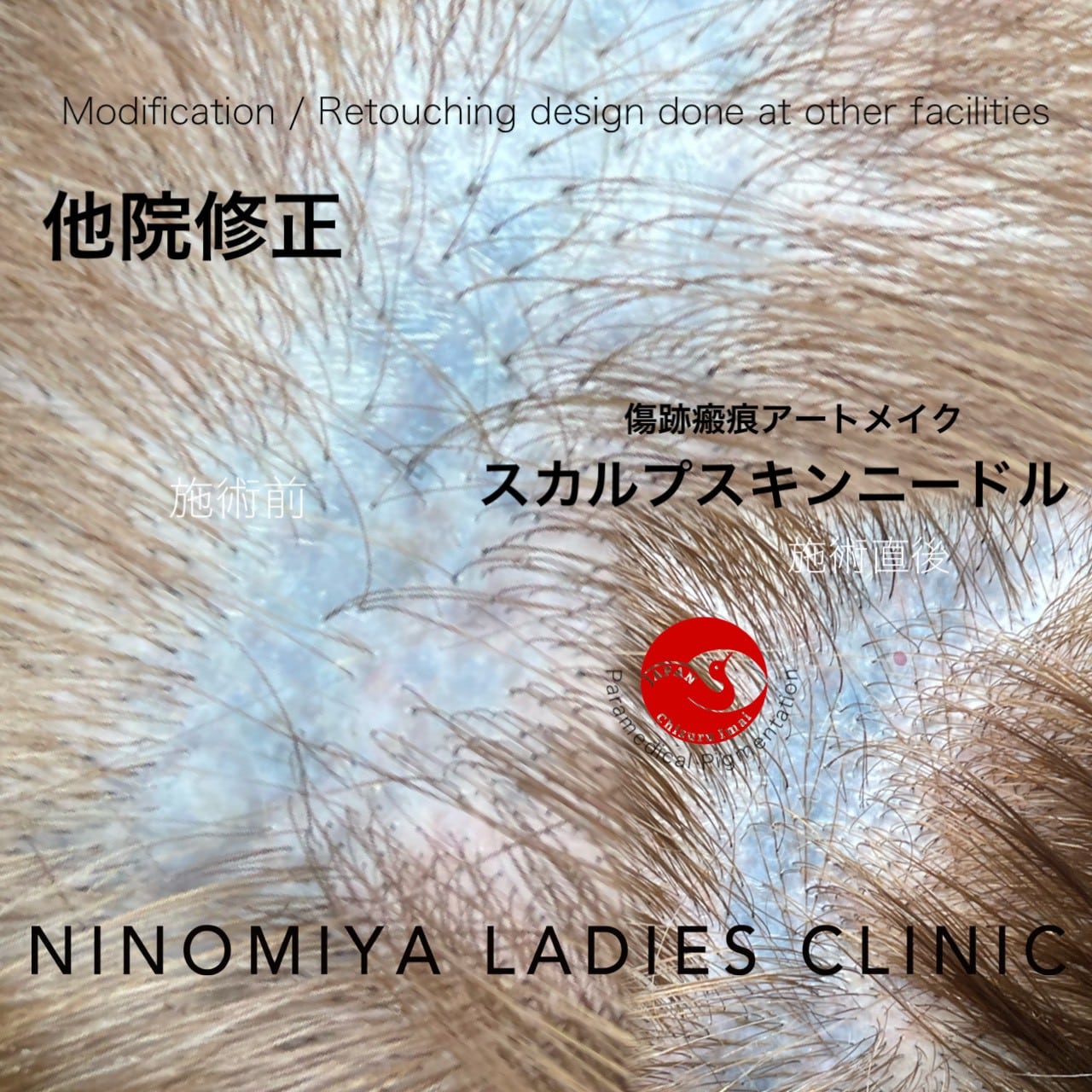 【傷痕・瘢痕】【スカルプスキンニードル】医療アートメイク