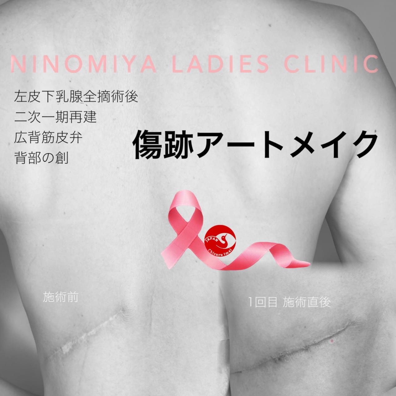 【傷痕・瘢痕】医療アートメイク