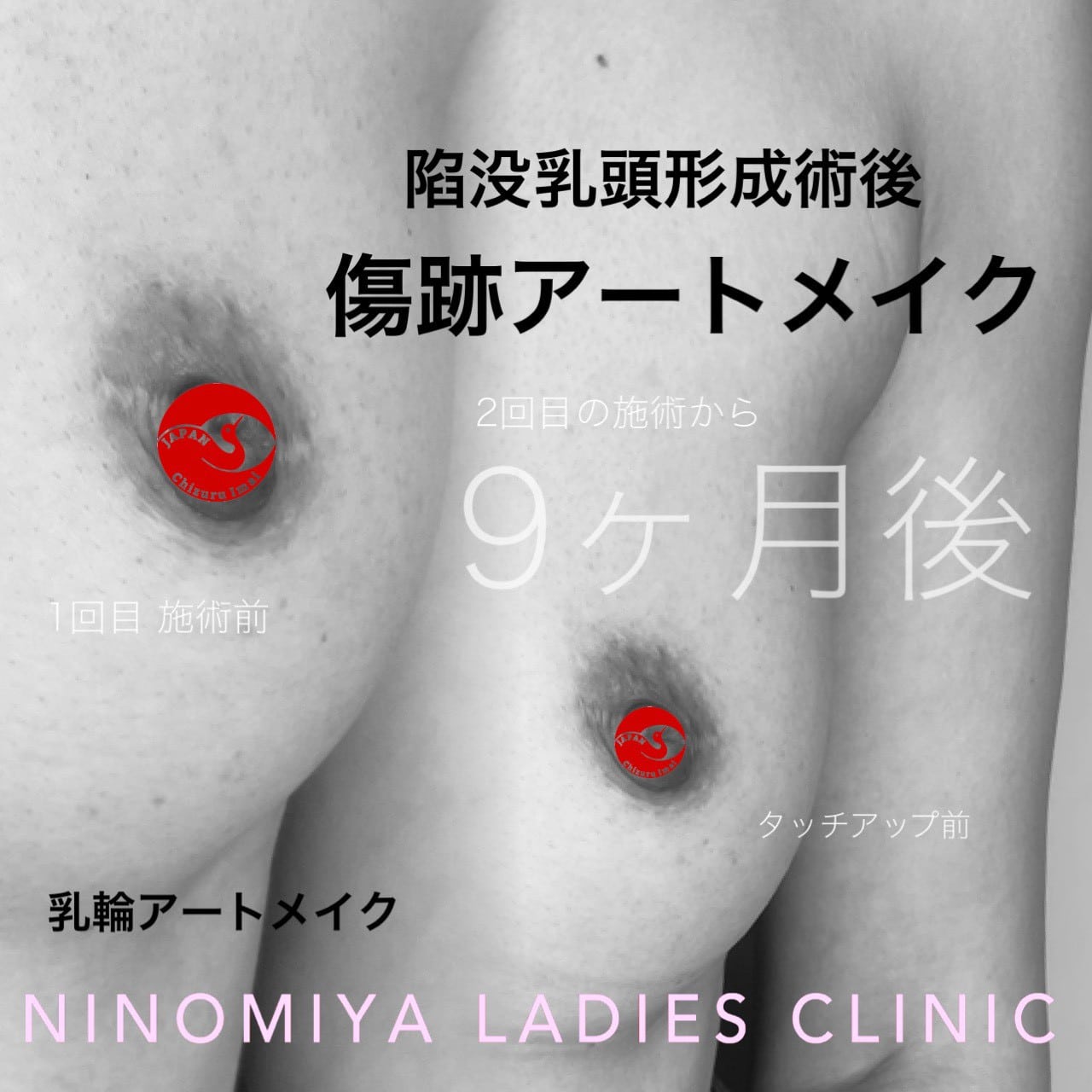 【乳輪・乳頭】医療アートメイク