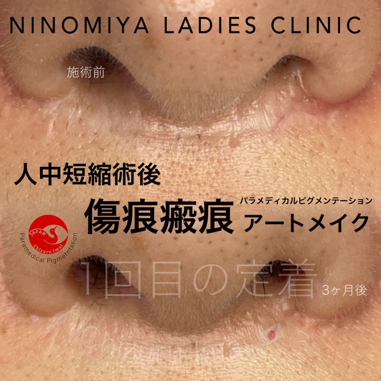 【傷痕・瘢痕】医療アートメイク
